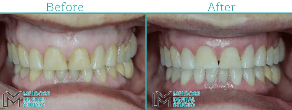 Teeth whitening before and after result, case 6, Melrose Dental Studio